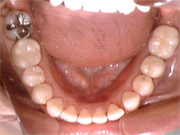 歯牙移植後